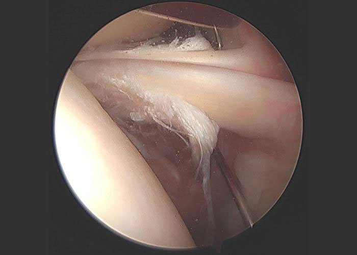 Biceps tendinitis or Proximal biceps rupture