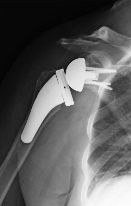 Shoulder Replacement Surgery